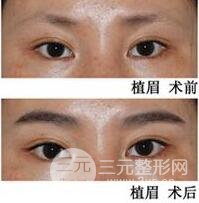 眉毛种植后还会脱落吗?