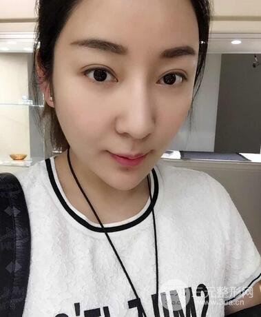 全脸线D图片 线D恢复过程图片