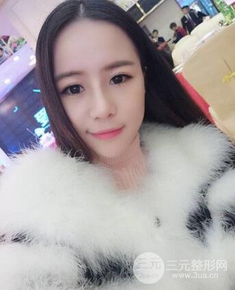 假体隆鼻恢复过程实例 前后果对比