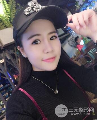 假体隆鼻恢复过程实例 前后果对比