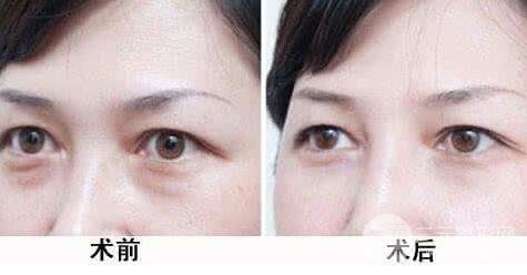 怎样去除下眼袋?去眼袋手术后六天照片