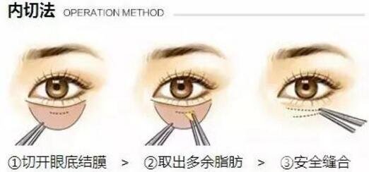 去眼袋手术果对比图