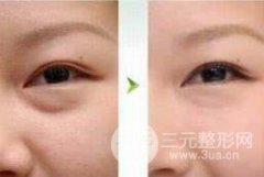 去除眼袋手术后几天可以拆线？