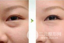 去除眼袋手术后几天可以拆线?