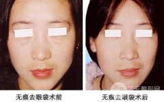 眼袋手术会留疤吗?