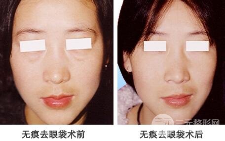 眼袋手术会留疤吗?