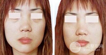 激光去眼袋多少钱呢？