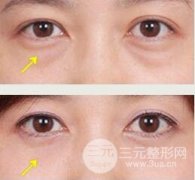 超声波去眼袋的果如何？