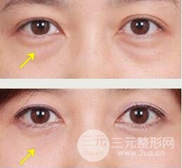 去眼袋图片