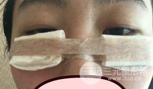 真人内切去眼袋手术过程对比图片和案例分享