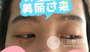 真人内切去眼袋手术过程对比图片和案例分享