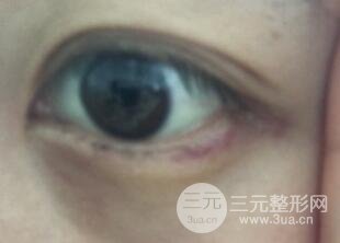 真人内切去眼袋手术过程对比图片和案例分享