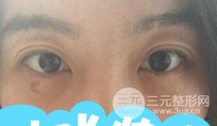 真人内切去眼袋手术过程对比图片和案例分享