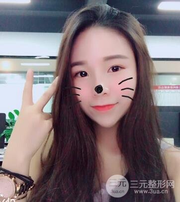 韩式生科隆鼻图片 深圳丽港丽格隆鼻整形归来