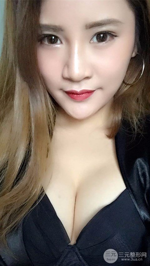 淄博阳光整形自体脂肪隆胸前后对比图，真实案例