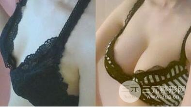 隆胸手术多少钱?假体隆胸后手感果真实自然吗?