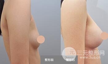 隆胸手术多少钱?假体隆胸后手感果真实自然吗?