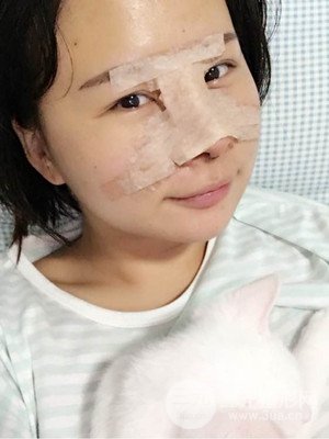 厦门思明安黛美邱健钦医生给我做的隆鼻整形手术，大家来看看果怎么样