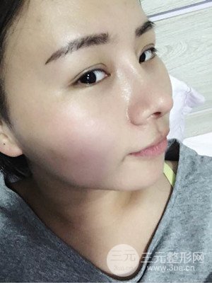 厦门思明安黛美邱健钦医生给我做的隆鼻整形手术，大家来看看果怎么样