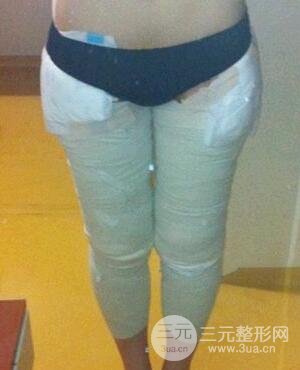 河南郑州大腿吸脂的真实案例,前后对比果图