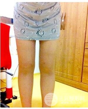 河南郑州大腿吸脂的真实案例,前后对比果图