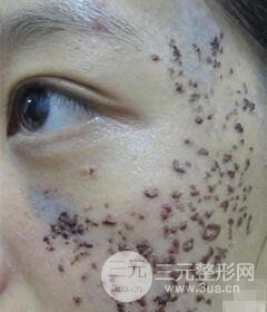 南宁缓解的太田痣真实案例,前后果对比图