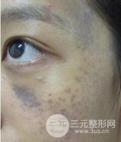 南宁缓解的太田痣真实案例,前后果对比图
