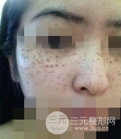 激光祛斑的恢复过程，逐步见证自己颜值的逐步提升。