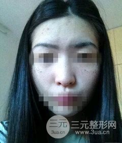 激光祛斑的恢复过程，逐步见证自己颜值的逐步提升。