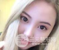 开内眼角和三点定位双眼皮恢复过程图片真人案例分享