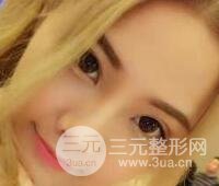 开内眼角和三点定位双眼皮恢复过程图片真人案例分享