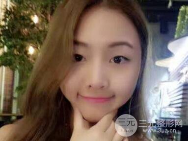 开内眼角和三点定位双眼皮恢复过程图片真人案例分享