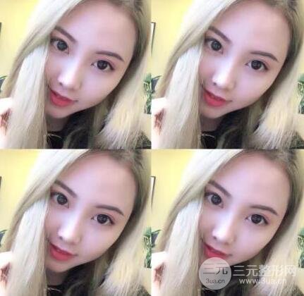 开内眼角和三点定位双眼皮恢复过程图片真人案例分享