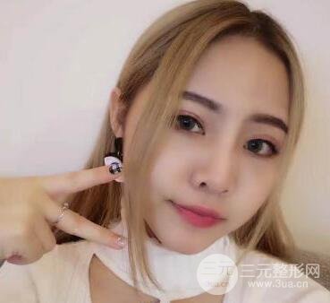 开内眼角和三点定位双眼皮恢复过程图片真人案例分享