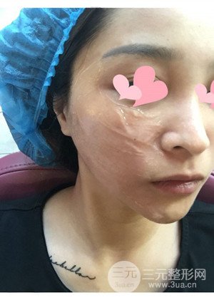 高强度聚焦超声手术前后过程以及真实案例分享——厦门思明安黛美林韵医生做的