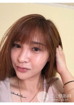 高强度聚焦超声手术前后过程以及真实案例分享——厦门思明安黛美林韵医生做的