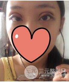 全切双眼皮整形真实案例,果对比,术后一定要忌口！
