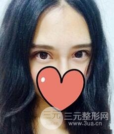 全切双眼皮整形真实案例,果对比,术后一定要忌口！