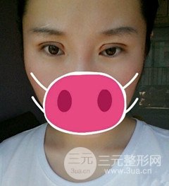 北京全切双眼皮手术真实案例，果对比图