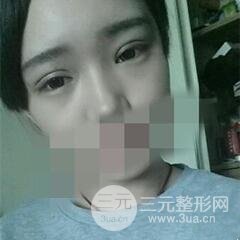 北三院三点定位双眼皮整形真实案例,果对比图