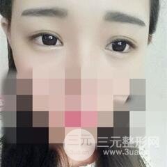 北三院三点定位双眼皮整形真实案例,果对比图