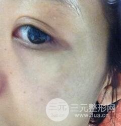 做了三次激光去太田痣，后来的果已经是我较为满意的了。