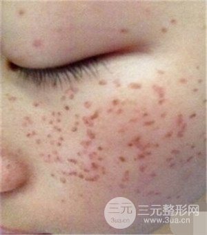 面部美白容整形激光祛斑手术恢复过程