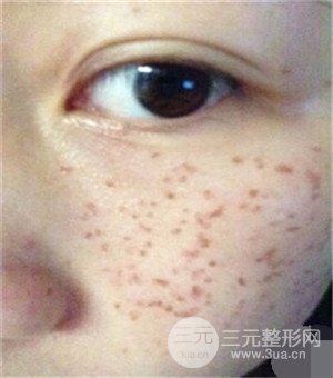 面部美白容整形激光祛斑手术恢复过程