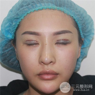 温州友好医院罗吉华眼部整形失败修复真人案例分享