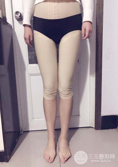 大腿抽脂真实过程图，轻松拥有细长双腿