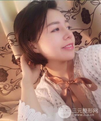 硅胶假体隆鼻+耳软骨垫鼻尖四个月恢复果图