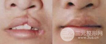 成人兔唇能完全修复吗?多少钱？