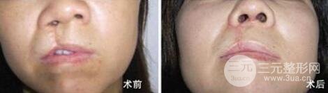 成人兔唇能完全修复吗?多少钱？