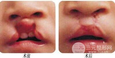 兔唇修复要做几次？